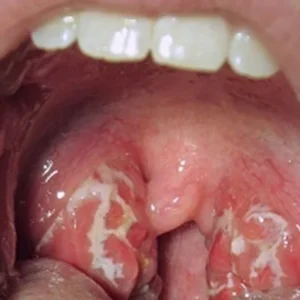 Read more about the article Practical Steps to Deal with Chlamydia Tonsils and Throat Rapidly