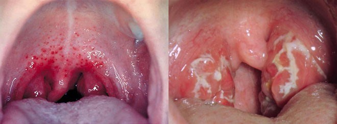 You are currently viewing Throat Herpes vs Strep Throat: Understanding the Differences Now