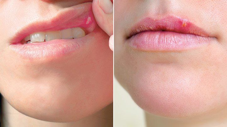 Read more about the article What is the Difference Between Cold Sore and Herpes on the Lips?